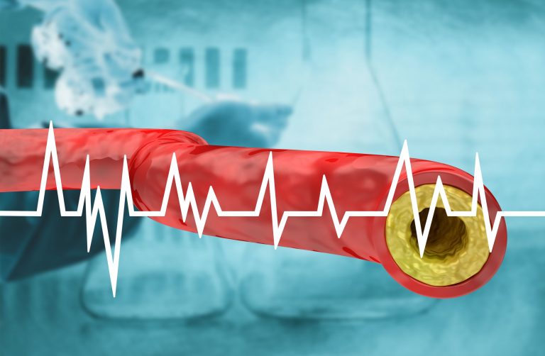 Radiomica folosită pentru a estima riscul de infarct miocardic