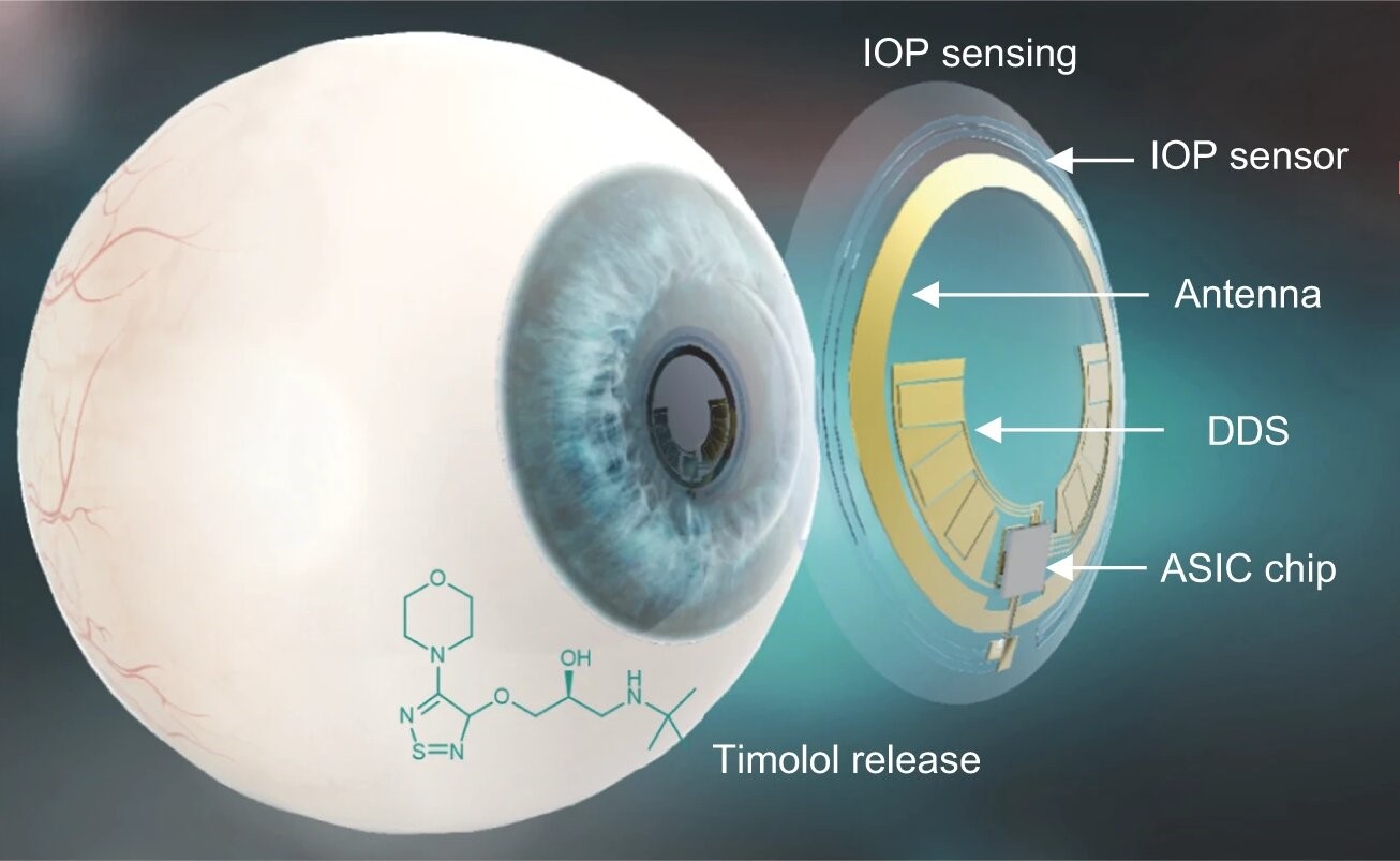 O lentilă de contact inteligentă care diagnostichează şi tratează glaucomul