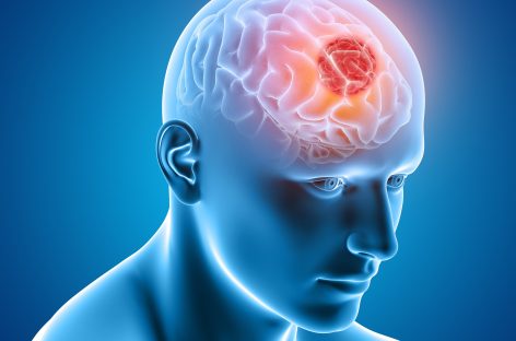 Un instrument de diagnostic dezvoltat de cercetători poate detecta cancerul cerebral în probele de urină