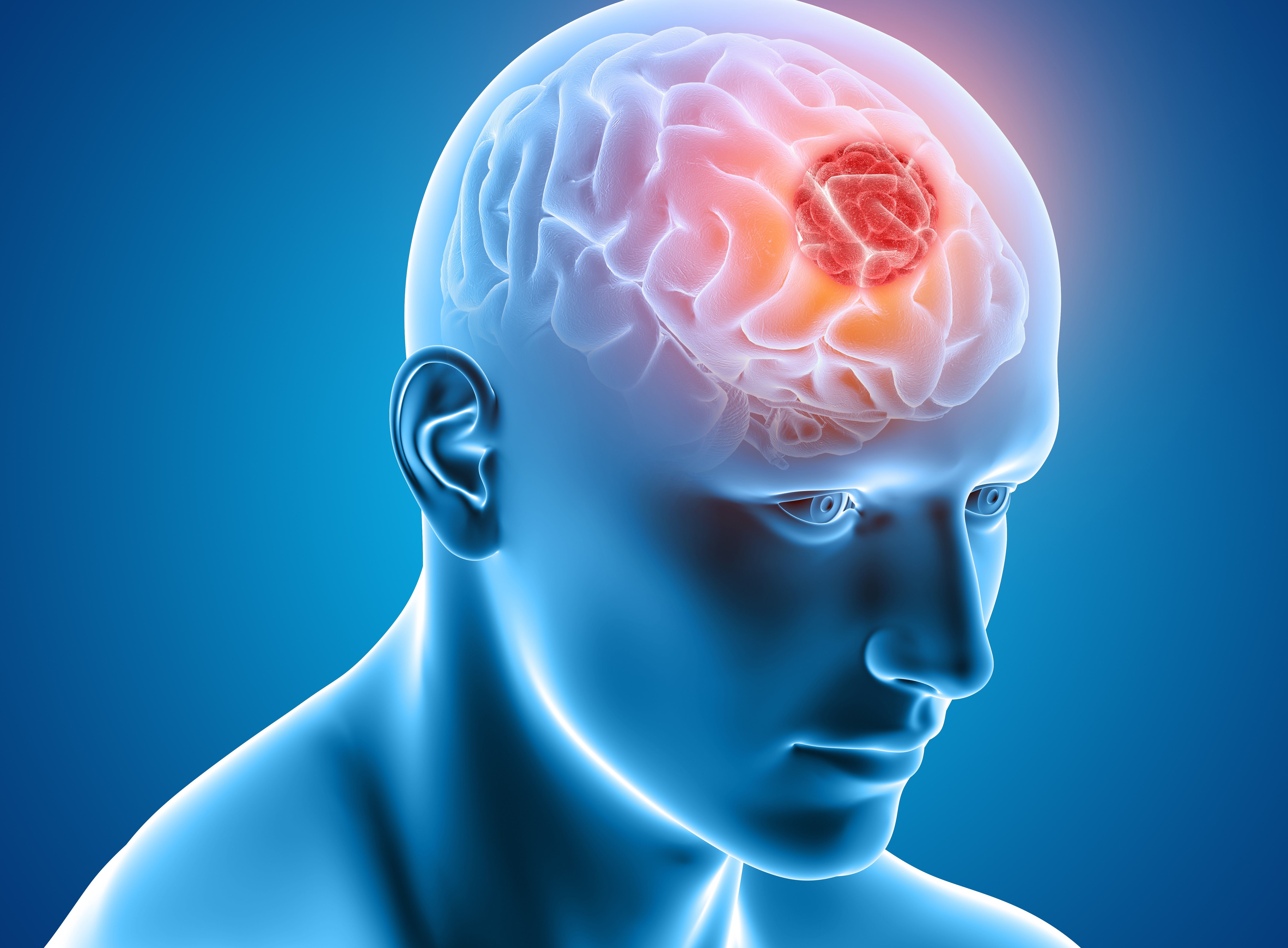 Un instrument de diagnostic dezvoltat de cercetători poate detecta cancerul cerebral în probele de urină