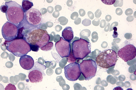 Cauza leucemiei în trisomia 21