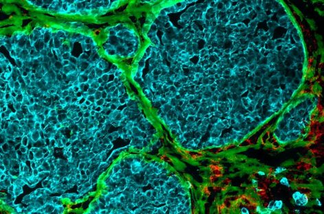 Cum transformă tumorile vasele de sânge