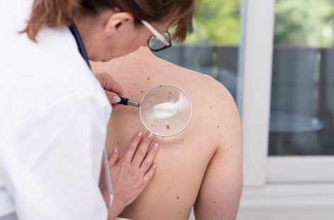 Screening gratuit la mare pentru riscul apariţiei cancerului cutanat