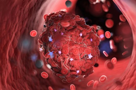 Un tratament inovator împotriva cheagurilor de sânge, aproape de testarea clinică