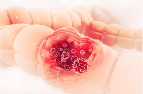 Managementul integrat al cancerului colorectal, la SANADOR