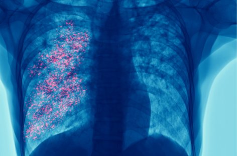 Abordare promiţătoare pentru eliminarea tuberculozei