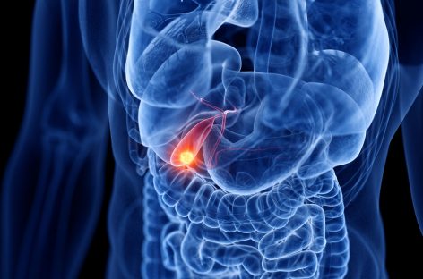 Oamenii de ştiinţă au stabilit Standardul pentru chirurgia cancerului de vezică biliară