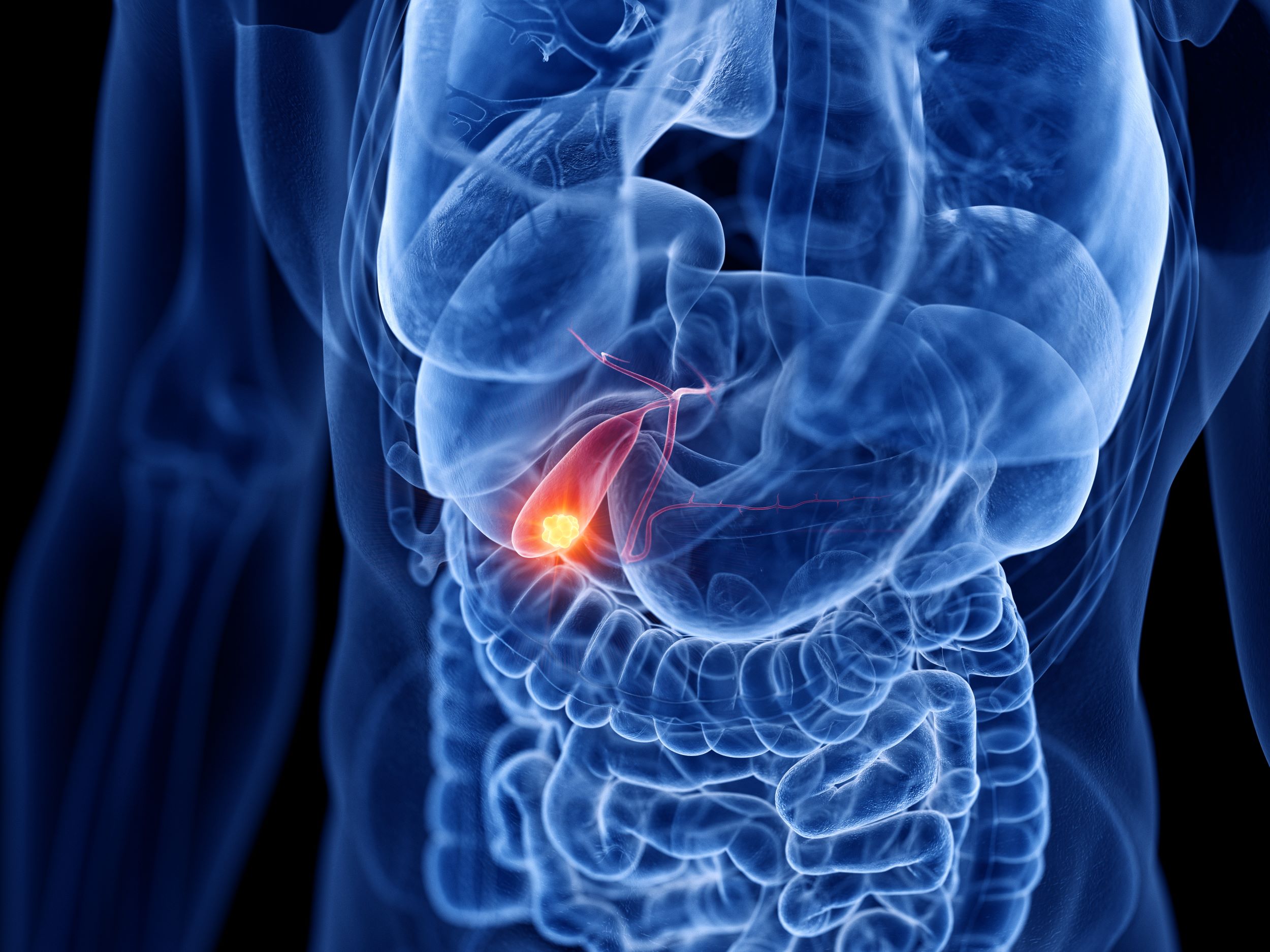 Oamenii de ştiinţă au stabilit Standardul pentru chirurgia cancerului de vezică biliară