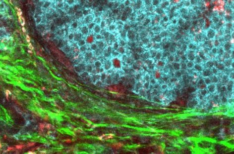 O nouă abordare promiţătoare în tratarea cancerelor rezistente