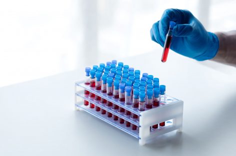 Analize medicale de rutină ar putea indica riscul crescut de demenţă