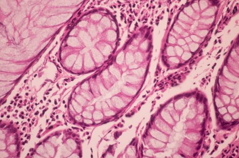 Cele mai mortale 10 tipuri de cancer. De ce nu există încă un remediu