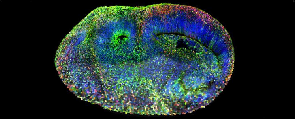 Creiere artificiale dezvăluie originile genetice ale tulburării de spectru autist