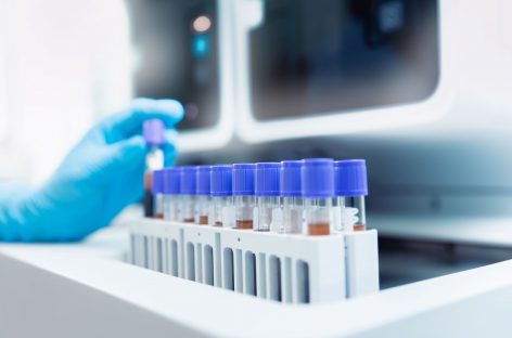 Diagnosticarea tulburării bipolare cu ajutorul unui simplu test de sânge