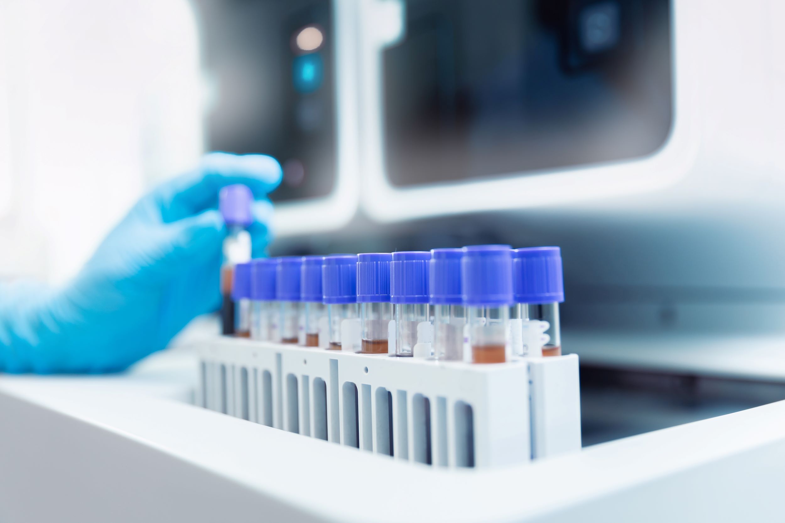 Diagnosticarea tulburării bipolare cu ajutorul unui simplu test de sânge