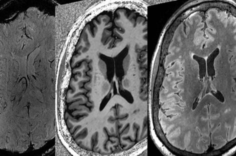 AI folosită pentru a estima recuperarea pacienţilor din comă după o leziune cerebrală gravă