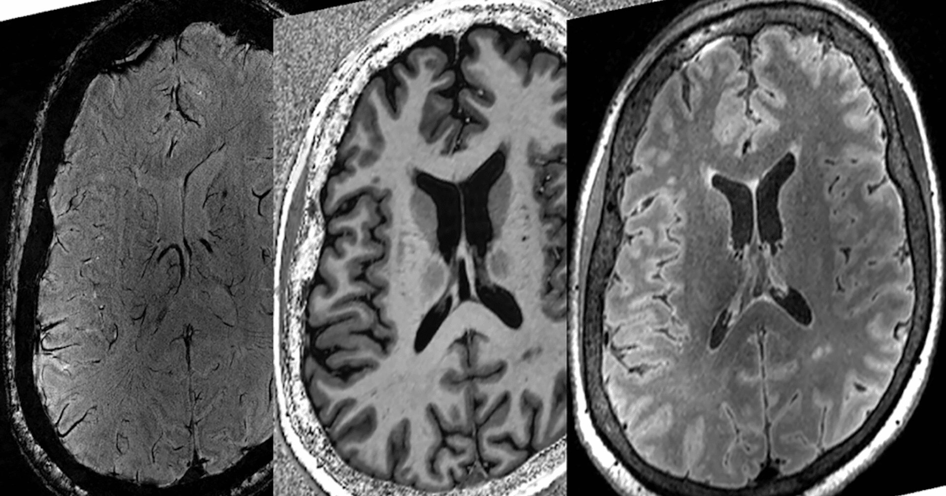 AI folosită pentru a estima recuperarea pacienţilor din comă după o leziune cerebrală gravă