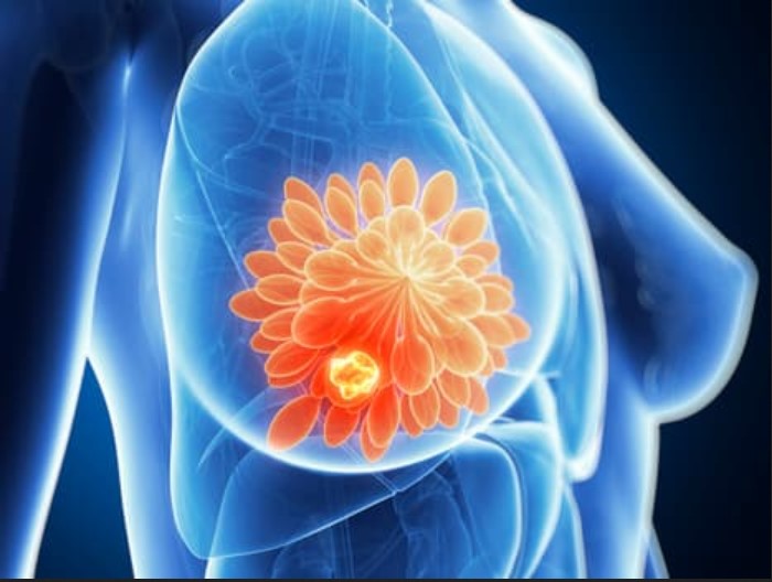 Recidiva cancerului de sân poate fi declanşată de leziunile provocate de chimioterapie asupra celulelor necanceroase, susţine un nou studiu