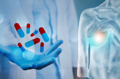 Nouă abordare potenţială de tratament pentru cancerul de sân triplu-negativ