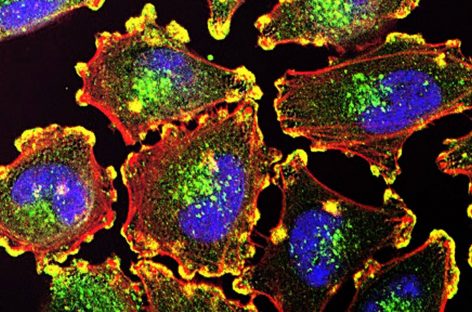 Cercetătorii americani au combinat trei tehnologii pentru a combate cancerul metastatic cu ajutorul luminii