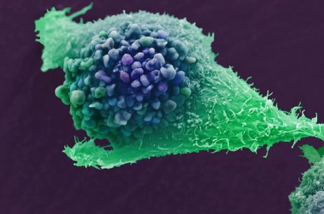 Oamenii de ştiinţă au reuşit să inverseze rezistenţa la medicamente în cazul cancerului de prostată