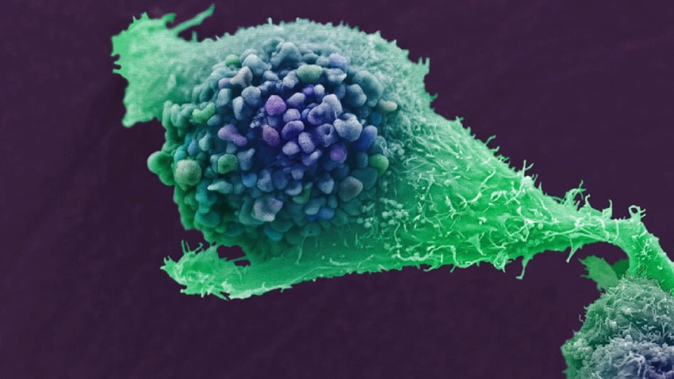 Oamenii de ştiinţă au reuşit să inverseze rezistenţa la medicamente în cazul cancerului de prostată