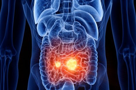 O proteină a sistemului imunitar poate combate cancerul intestinal în stadii incipiente, a descoperit un studiu australian