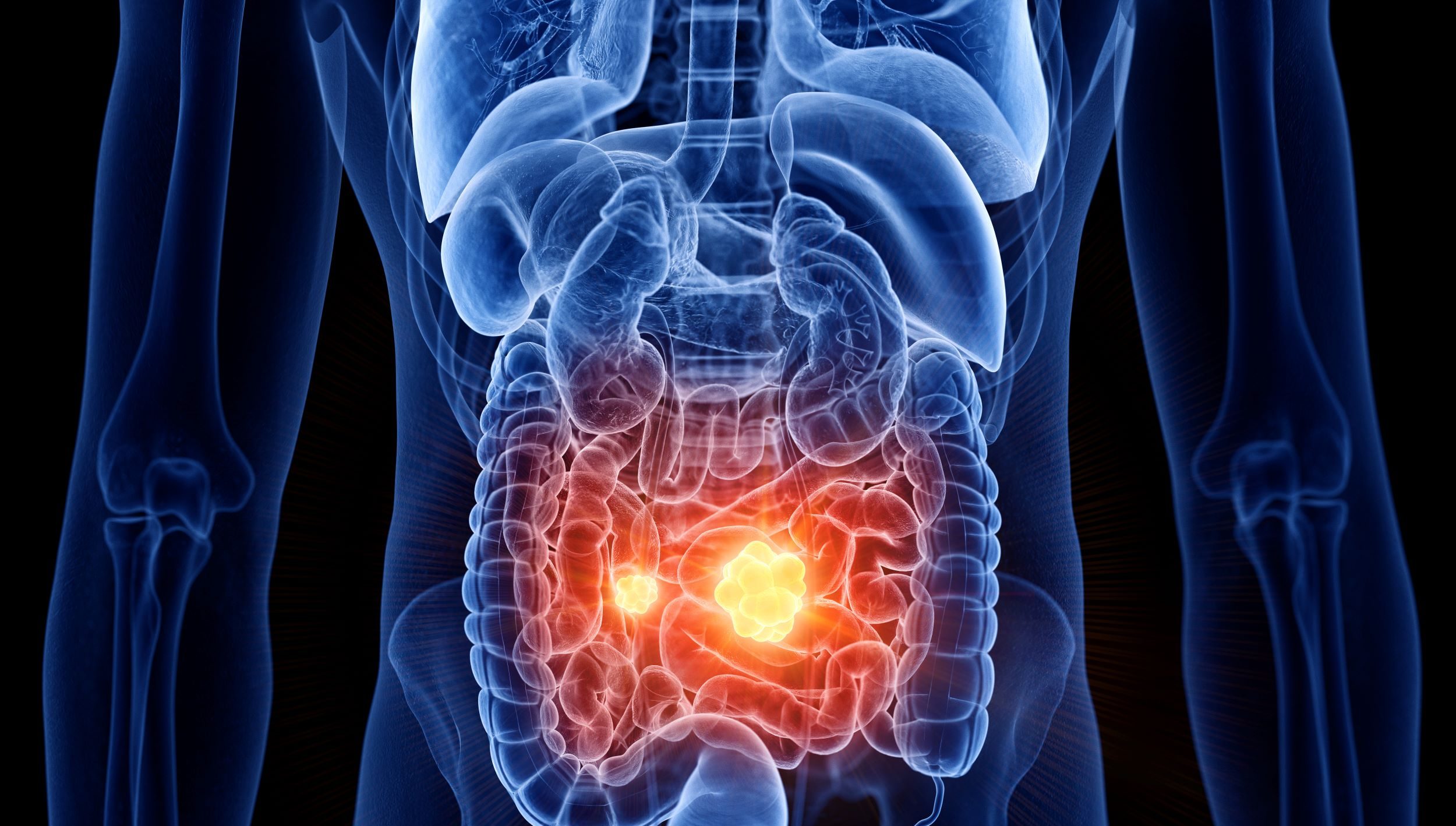 O proteină a sistemului imunitar poate combate cancerul intestinal în stadii incipiente, a descoperit un studiu australian