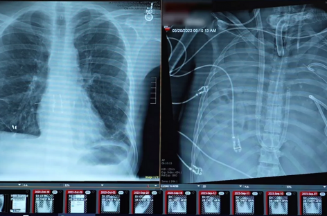 Implanturi mamare folosite într-o procedură inovatoare în SUA pentru salvarea unui tânăr cu leziuni pulmonare grave