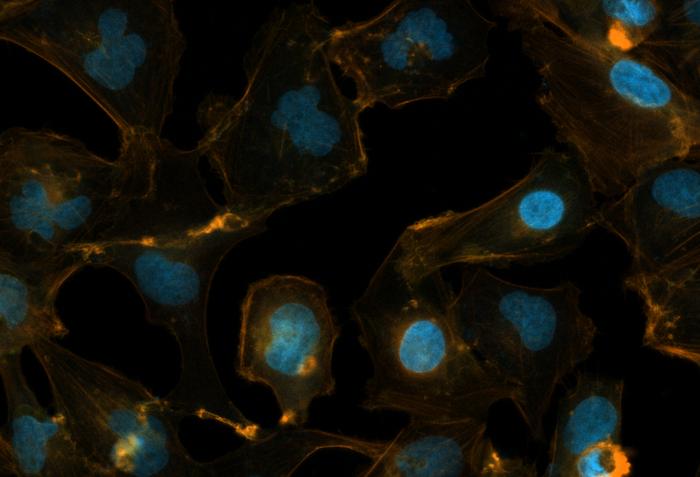 O proteină asociată cu bolile neurodegenerative este legată şi de cancerul cerebral la copii, au descoperit oamenii de ştiinţă