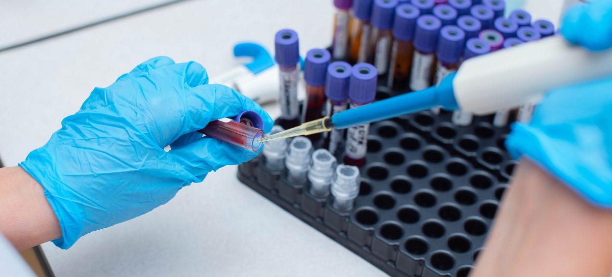 Cercetătorii au identificat noi biomarkeri din sânge pentru riscul de boli cardiovasculare la pacienţii cu artrită reumatoidă