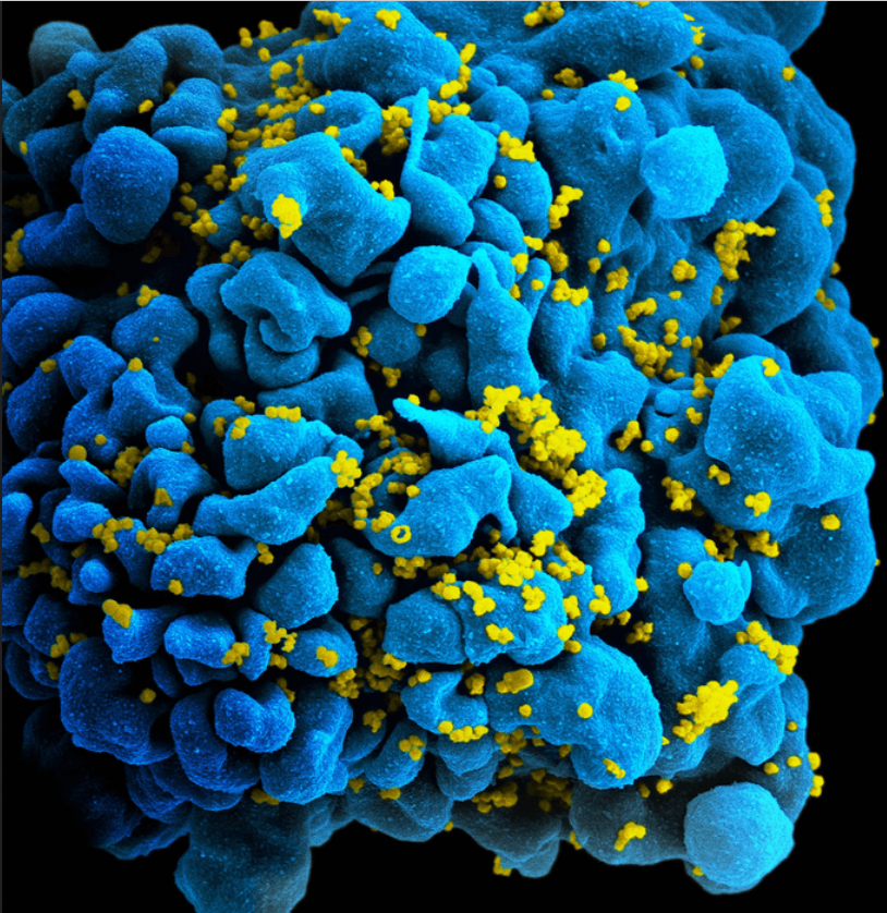 Au fost identificate primele cazuri documentate de transmitere a HIV prin intermediul acelor cosmetice