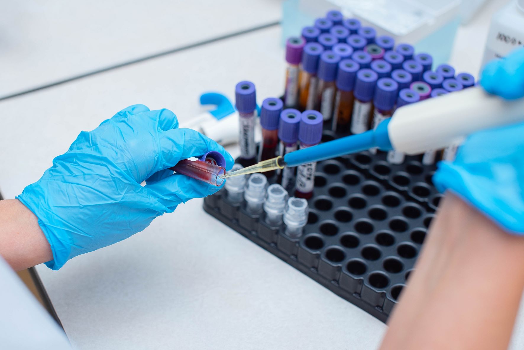 Marea Britanie lansează un studiu pentru validarea testelor de sânge care să diagnosticheze demenţa Alzheimer
