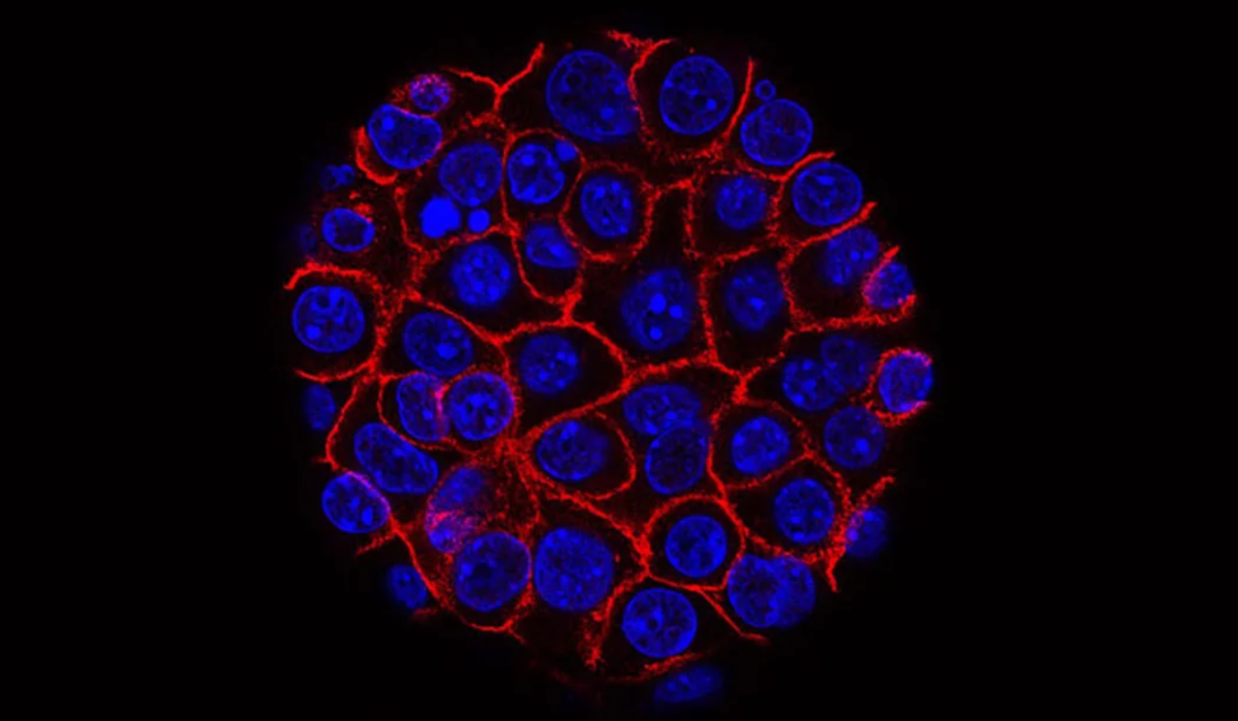 Nouă ţintă terapeutică promiţătoare în cancerul pancreatic