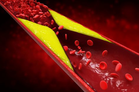 Tehnologie promiţătoare pentru diagnosticarea şi tratarea aterosclerozei
