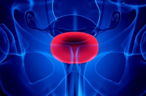 Un medicament experimental pentru cancerul vezicii urinare a obţinut rezultate pozitive într-un studiu clinic