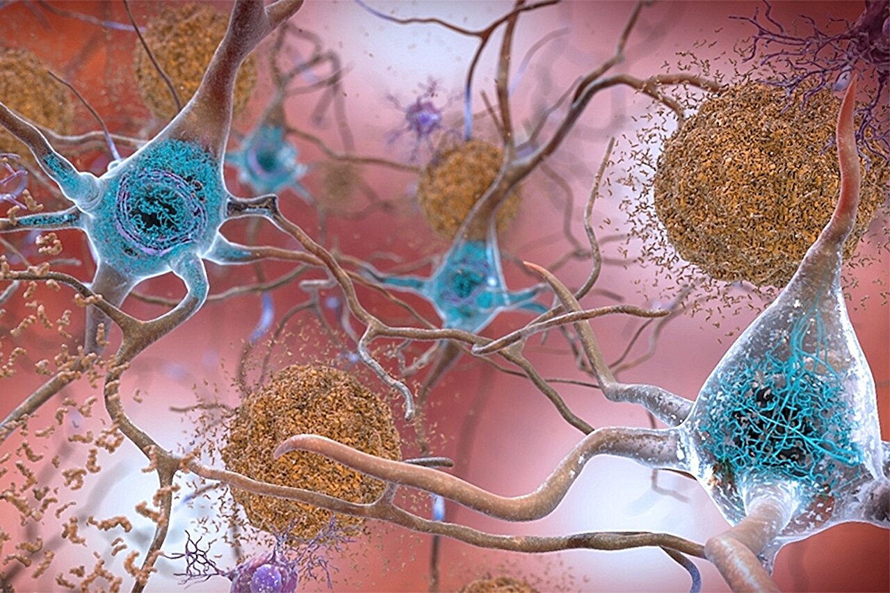 Ce se întâmplă de fapt în creierul Alzheimer? O tehnică imagistică sofisticată a surprins formarea proteinelor toxice care agravează boala