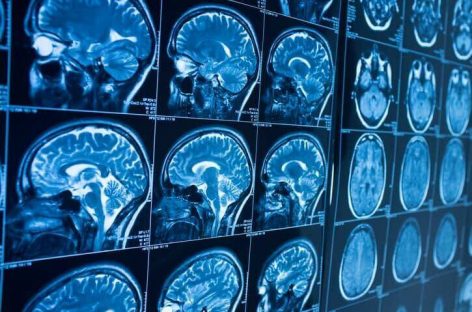 Un medicament autorizat, promiţător în tratarea tumorilor cerebrale rezultate din cancerul de sân