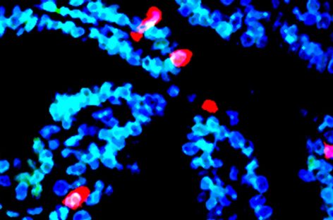 Cercetătorii au identificat originea celui mai mortal cancer ovarian şi mecanisme pentru diagnostic şi potenţiale terapii